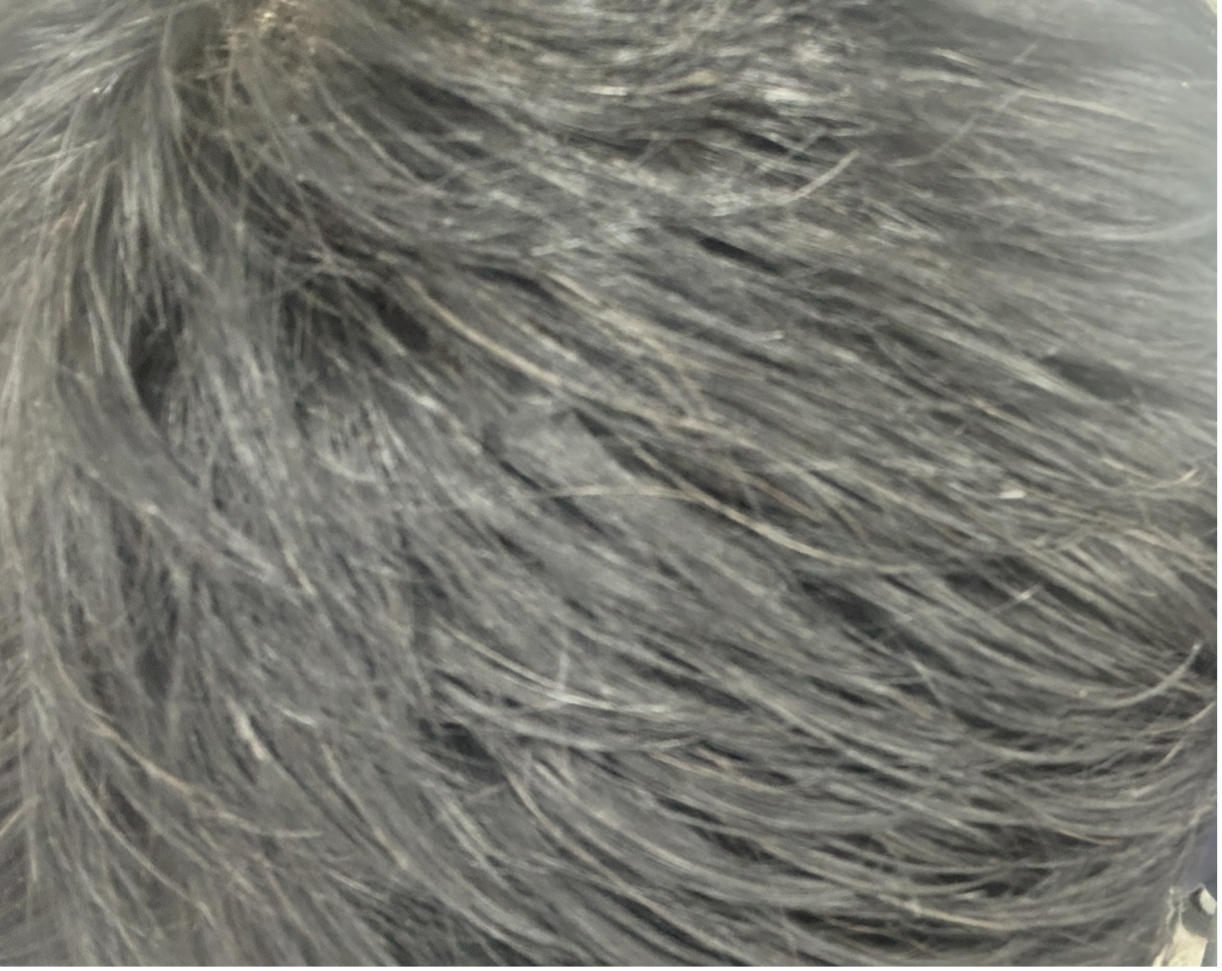 사용 11주 후 — 11월 두피 상태