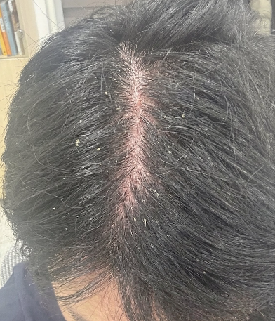 사용 시작 전 — 8월 두피 상태